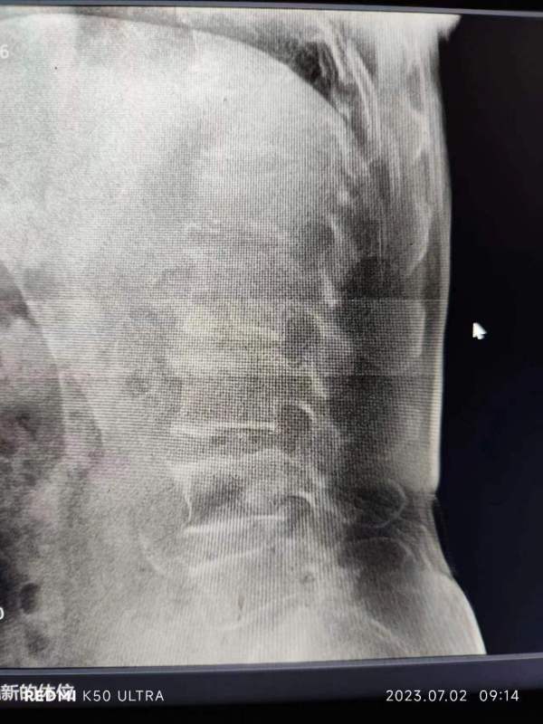 便携式DRx光机一般几次曝光 多次曝光辐射大吗